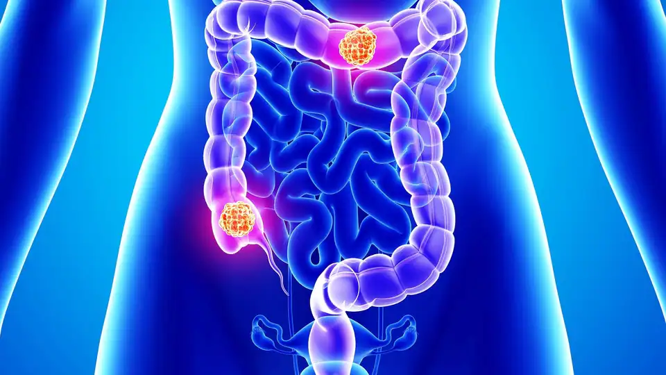 Could a gut repair switch also help colorectal  cancer ?